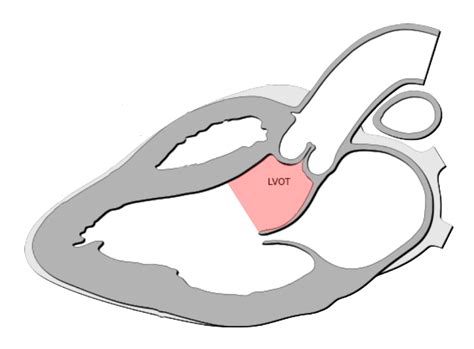 hypertrophic left ventricular outflow tract.